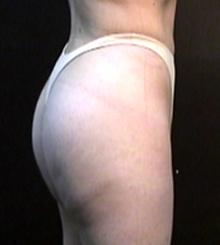 after Brazilian Butt Lift 3