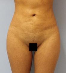 after Body Sculpting 9