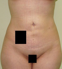 after Body Sculpting 2