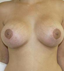 after Breast Lift 12