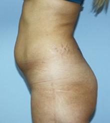 before Body Sculpting 8
