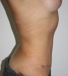 after Tummy Tuck 4