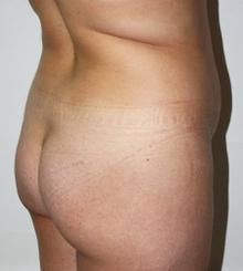 before Brazilian Butt Lift 21