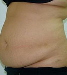 before Tummy Tuck 1
