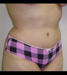 after Tummy Tuck 6