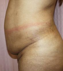 before Body Sculpting 12