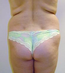 before Brazilian Butt Lift 1