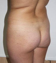 before Brazilian Butt Lift 21