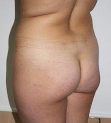 before Brazilian Butt Lift 21