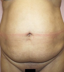 before Body Sculpting 12