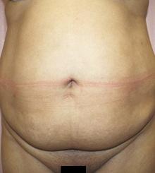 before Body Sculpting 12