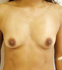 before Breast Augmentation 31