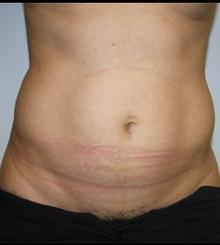 before Body Sculpting 3