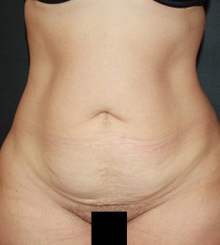 before Tummy Tuck 15