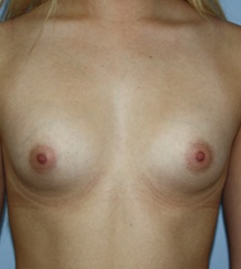 before Breast Augmentation 43