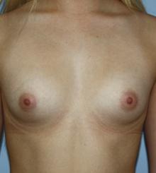 before Breast Augmentation 43