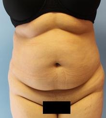 before Body Sculpting 4