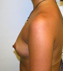 before Breast Augmentation 33