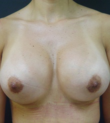 after Breast Augmentation 44