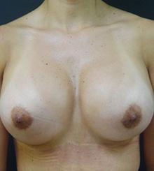 after Breast Augmentation 44