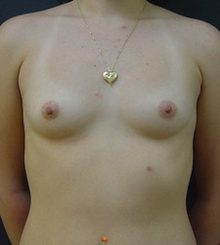 before Breast Augmentation 26