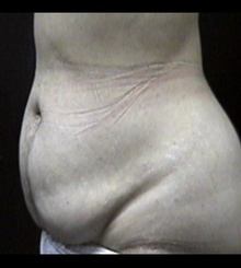 before Tummy Tuck 9