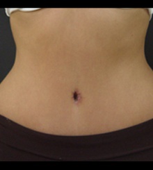 after Tummy Tuck 7