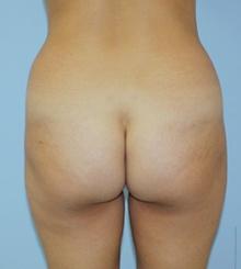 before Brazilian Butt Lift 19