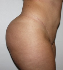after Brazilian Butt Lift 30