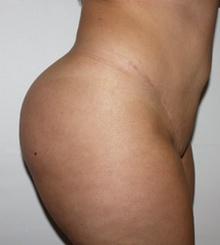 after Brazilian Butt Lift 30