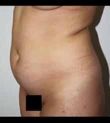 before Body Sculpting 13