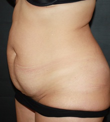 before Tummy Tuck 15