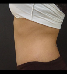 after Tummy Tuck 7