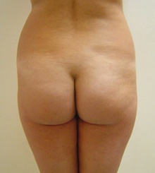 before Brazilian Butt Lift 16