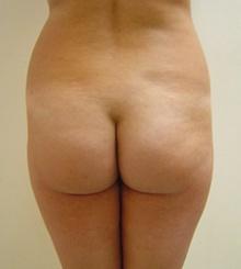 before Brazilian Butt Lift 16