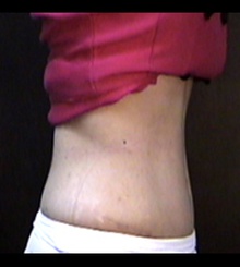 after Tummy Tuck 9