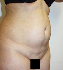 before Brazilian Butt Lift 24