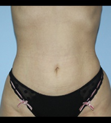 after Body Sculpting 14