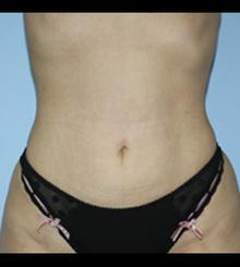 after Body Sculpting 14