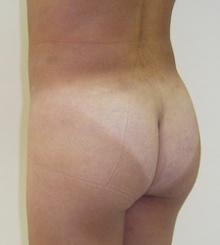 after Brazilian Butt Lift 17