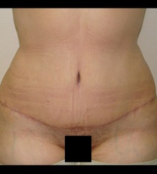 after Tummy Tuck 5