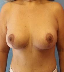 after Breast Lift 18