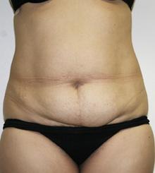 before Tummy Tuck 11
