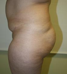 before Brazilian Butt Lift 14