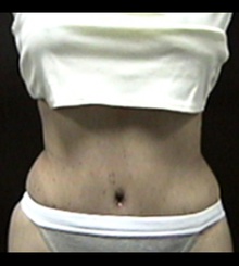 after Tummy Tuck 9