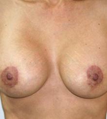 after Breast Lift 13