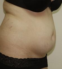 before Body Sculpting 10