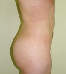 after Body Sculpting 2
