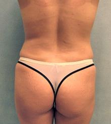 before Brazilian Butt Lift 6