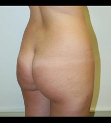 before Brazilian Butt Lift 9
